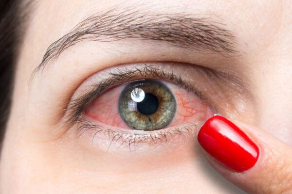 নারীদের চোখের যে রোগগুলো বেশি হয়