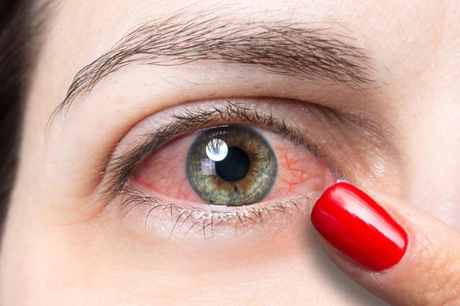 নারীদের চোখের যে রোগগুলো বেশি হয়